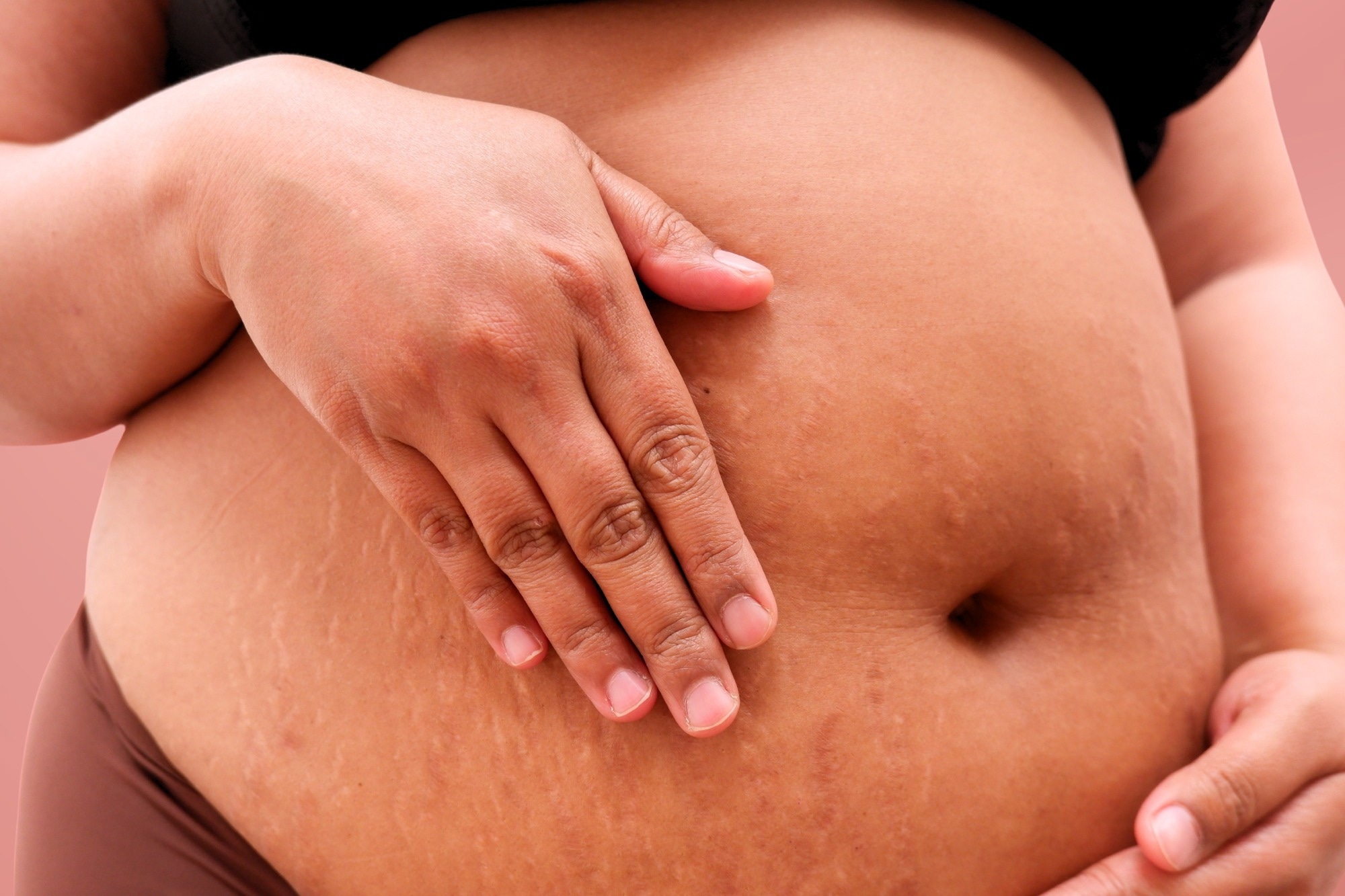 Meta-analyzes find no clear rise in birth defects after GLP-1 exposure in pregnancy