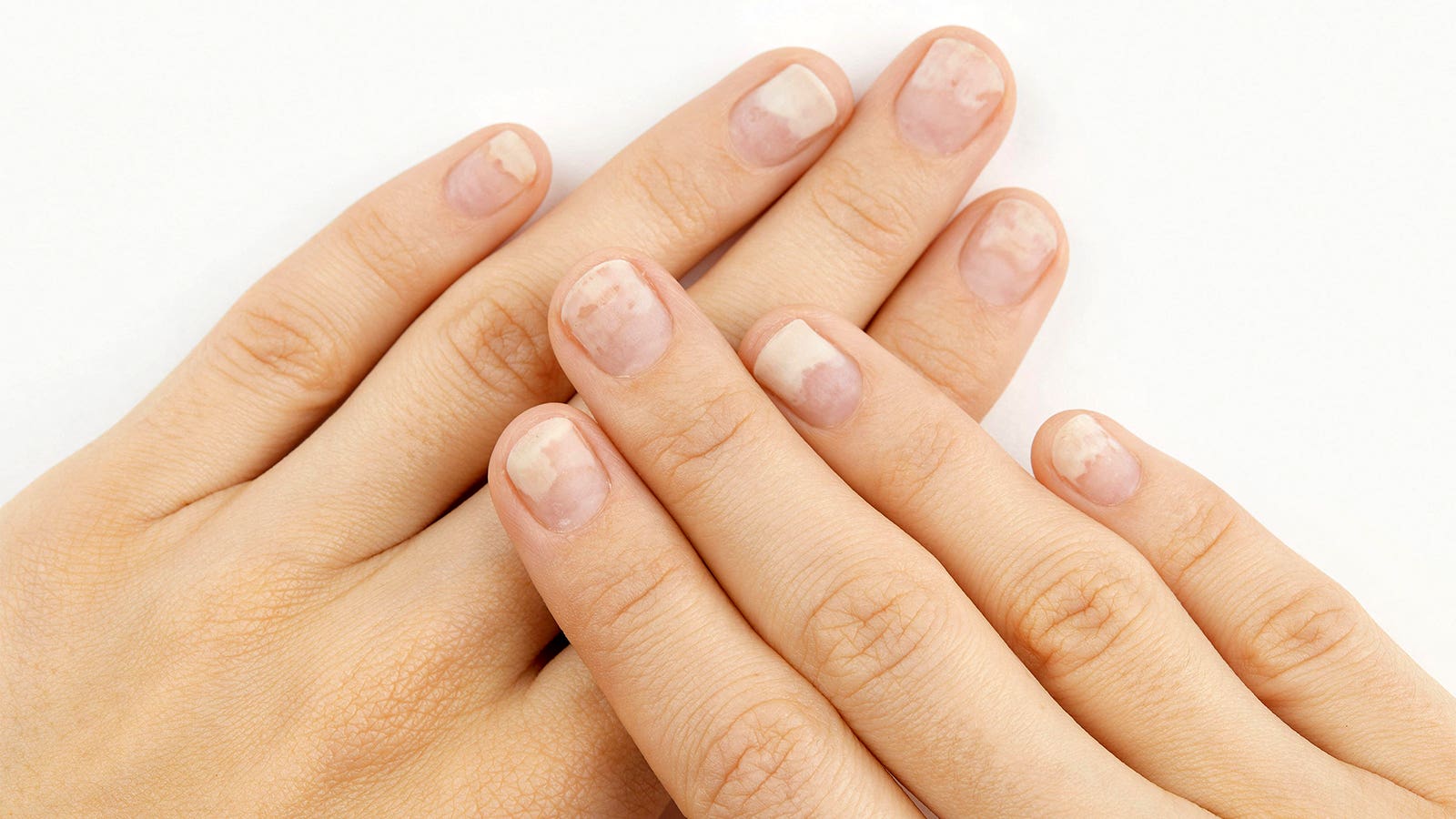 GLP-1 users report more nail disorders, including detachment, in EADV study