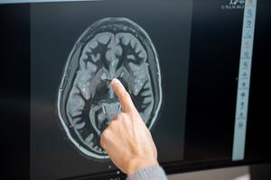 Brain recordings suggest tirzepatide's effect on food noise may fade after about five months