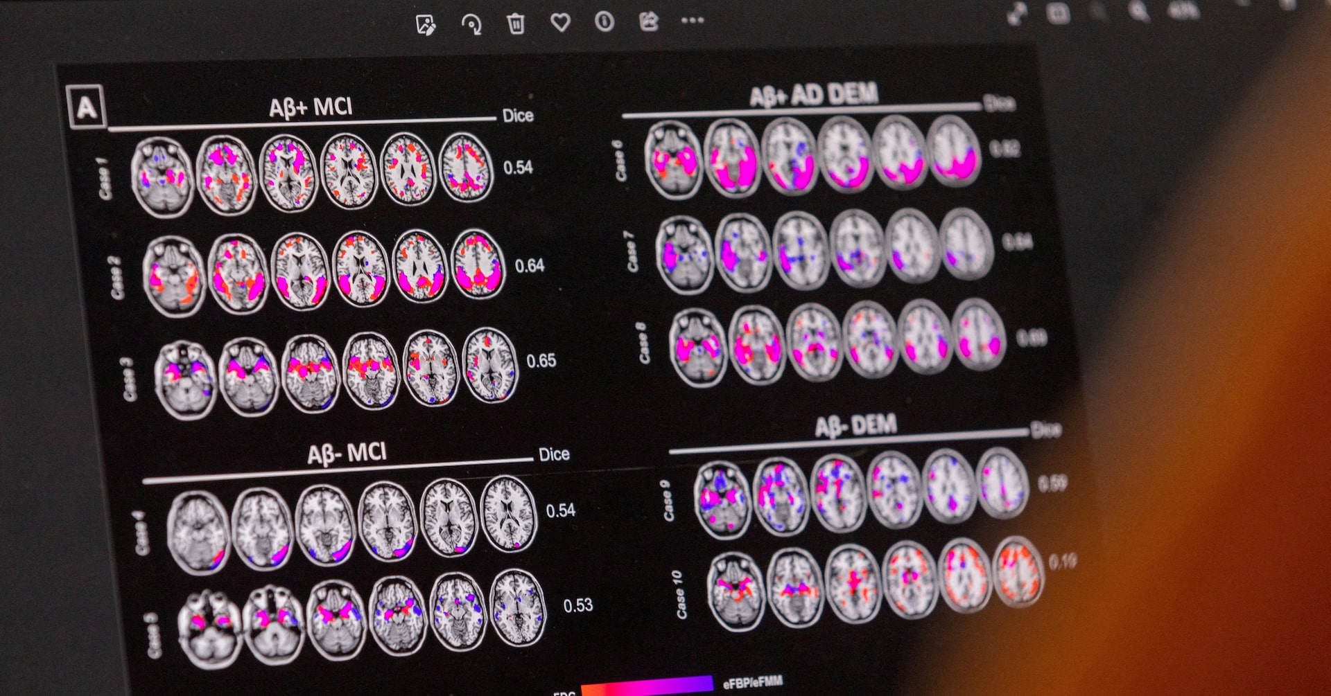 Novo Nordisk says oral semaglutide failed to slow Alzheimer's in two phase 3 trials