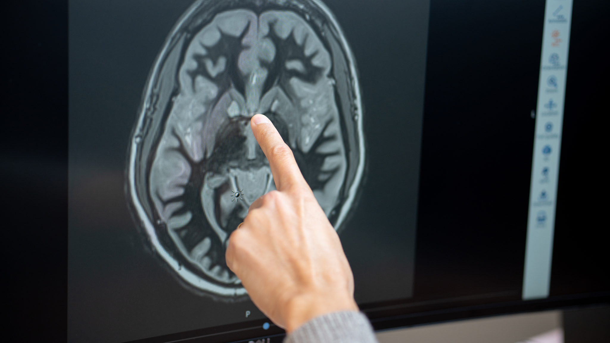 Brain recordings suggest tirzepatide's effect on food noise may fade after about five months